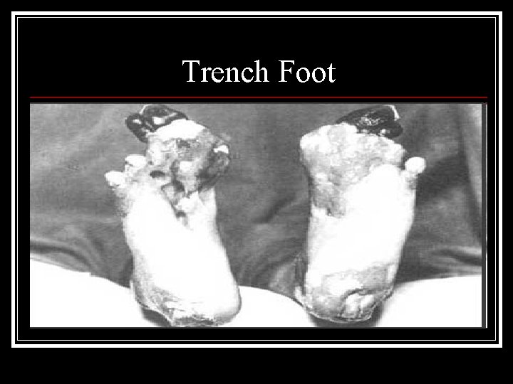 Trench Foot 