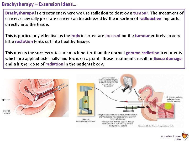 Brachytherapy – Extension Ideas… Brachytherapy is a treatment where we use radiation to destroy