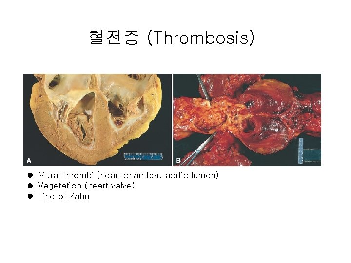 혈전증 (Thrombosis) l Mural thrombi (heart chamber, aortic lumen) l Vegetation (heart valve) l