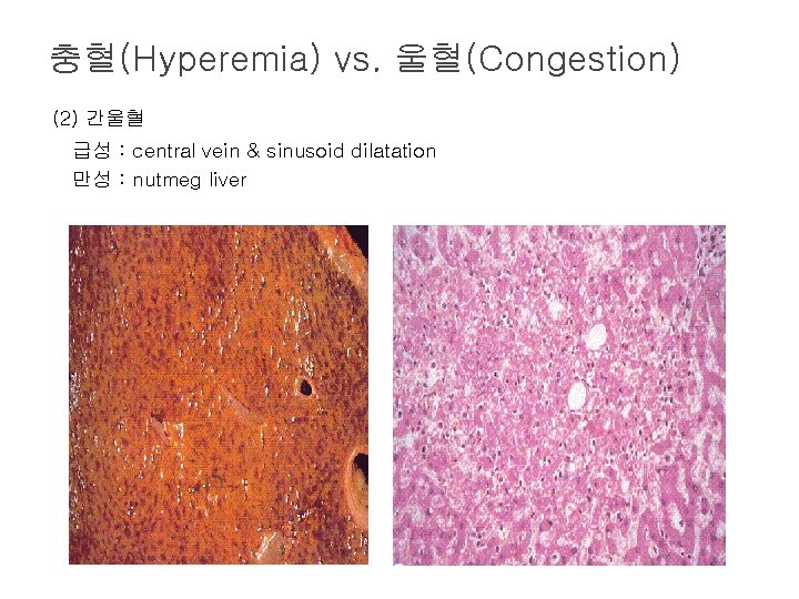 충혈(Hyperemia) vs. 울혈(Congestion) (2) 간울혈 급성 : central vein & sinusoid dilatation 만성 :