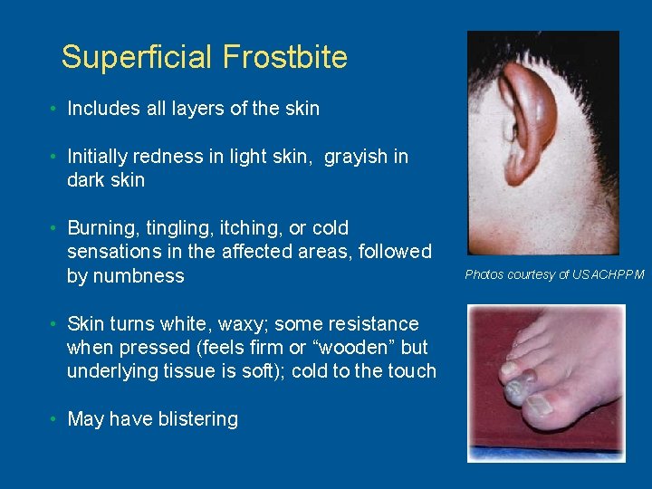 Superficial Frostbite • Includes all layers of the skin • Initially redness in light