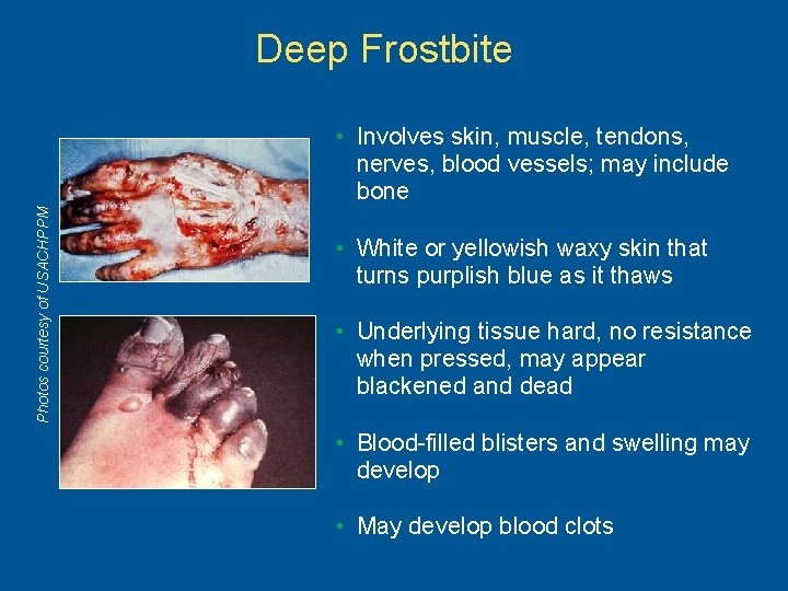 Deep Frostbite Photos courtesy of USACHPPM • Involves skin, muscle, tendons, nerves, blood vessels;