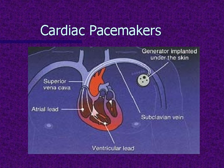 Cardiac Pacemakers 