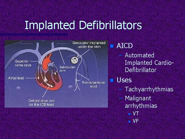 Implanted Defibrillators n AICD – Automated Implanted Cardio. Defibrillator n Uses – Tachyarrhythmias –