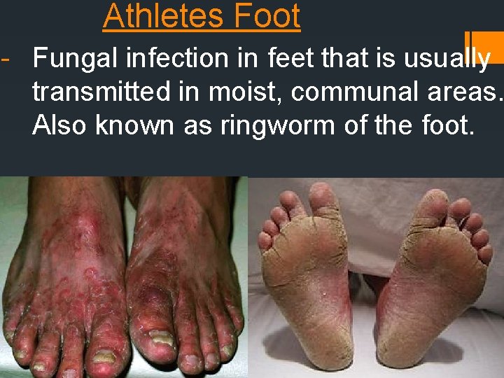 Athletes Foot - Fungal infection in feet that is usually transmitted in moist, communal