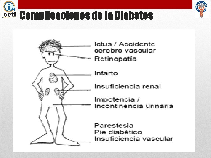Complicaciones de la Diabetes 