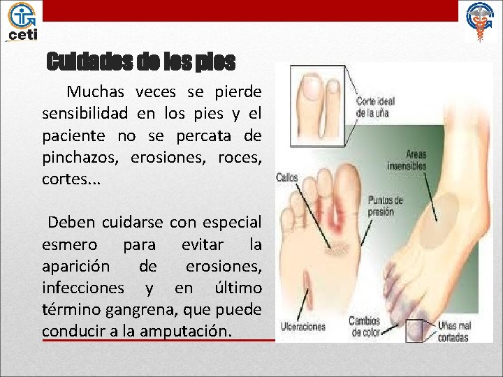 Cuidados de los pies Muchas veces se pierde sensibilidad en los pies y el