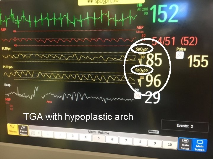 TGA with hypoplastic arch 