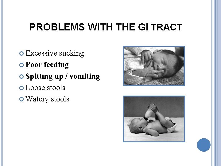 PROBLEMS WITH THE GI TRACT Excessive sucking Poor feeding Spitting up / vomiting Loose