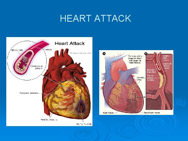 HEART ATTACK HEART ATTACK