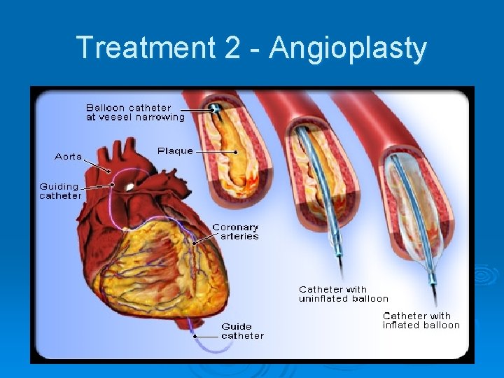 Treatment 2 - Angioplasty Treatment 2 - Angioplasty