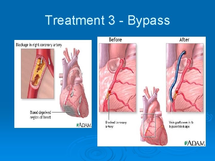 Treatment 3 - Bypass Treatment 3 - Bypass