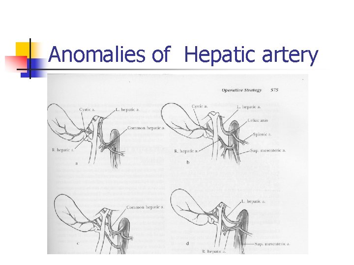 Anomalies of Hepatic artery 