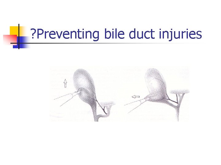 ? Preventing bile duct injuries 