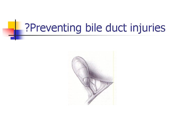 ? Preventing bile duct injuries 