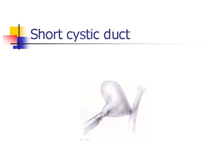 Short cystic duct 