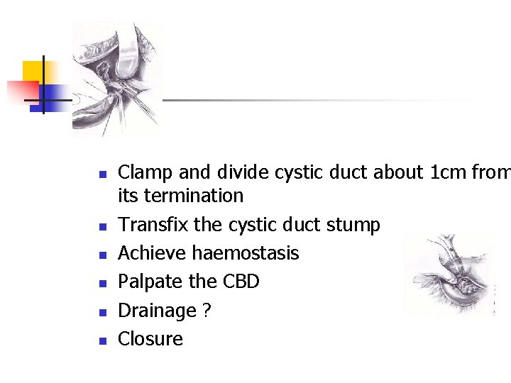 n n n Clamp and divide cystic duct about 1 cm from its termination