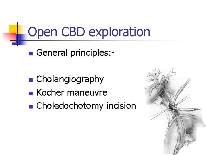 Open CBD exploration n n General principles: Cholangiography Kocher maneuvre Choledochotomy incision 