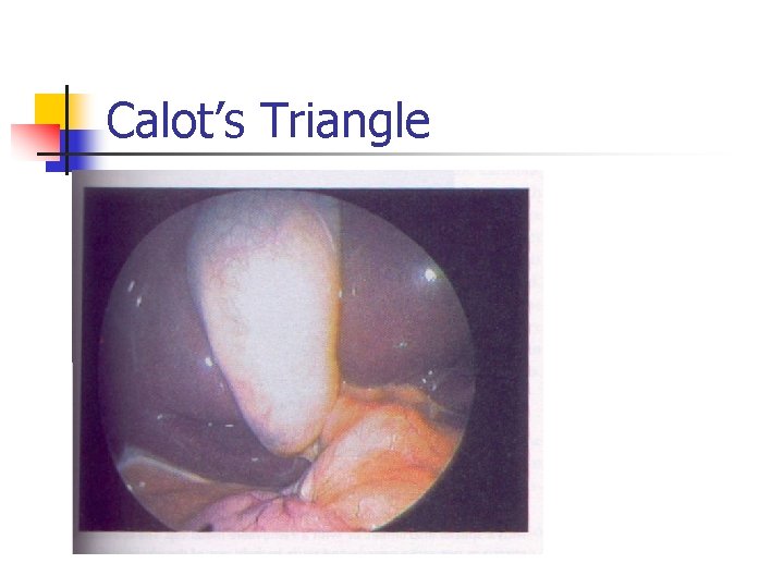 Calot’s Triangle 