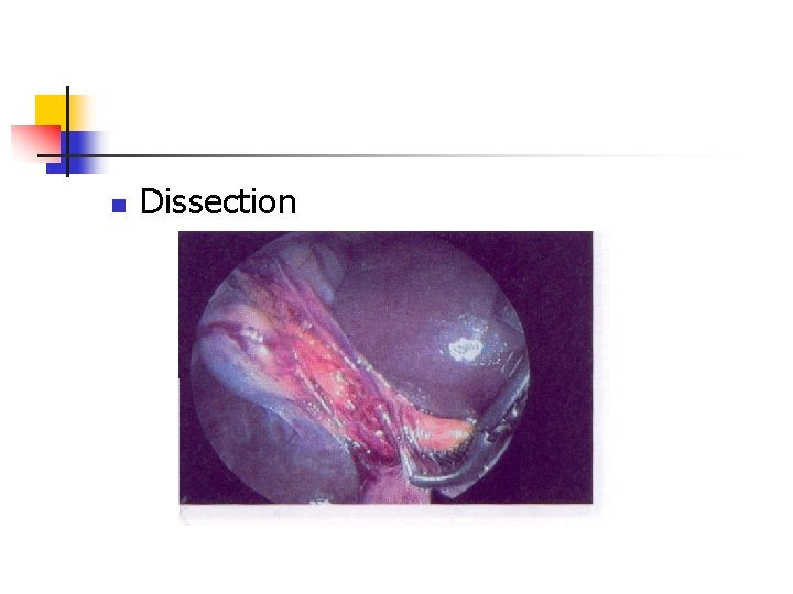 n Dissection 