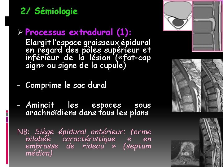 2/ Sémiologie Ø Processus extradural (1): - Elargit l’espace graisseux épidural en regard des