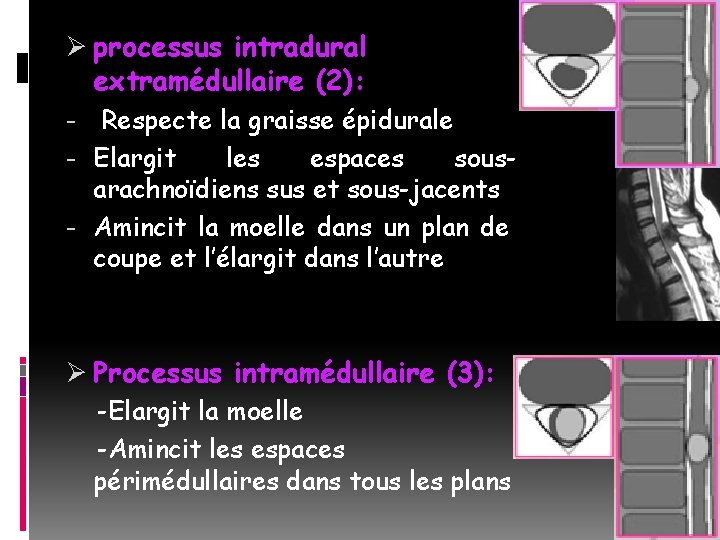 Ø processus intradural extramédullaire (2): - Respecte la graisse épidurale - Elargit les espaces