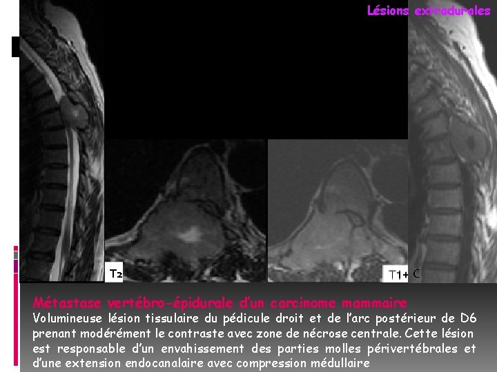 Lésions extradurales T 2 Métastase vertébro-épidurale d’un carcinome mammaire C Volumineuse lésion tissulaire du