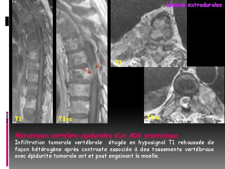 Lésions extradurales T 1 T 1+c Métastases vertébro-épidurales d’un ADK prostatique Infiltration tumorale vertébrale