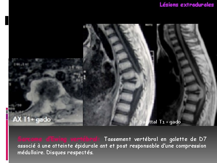 Lésions extradurales Sagittal T 1 + gado Sarcome d’Ewing vertébral: Tassement vertébral en galette