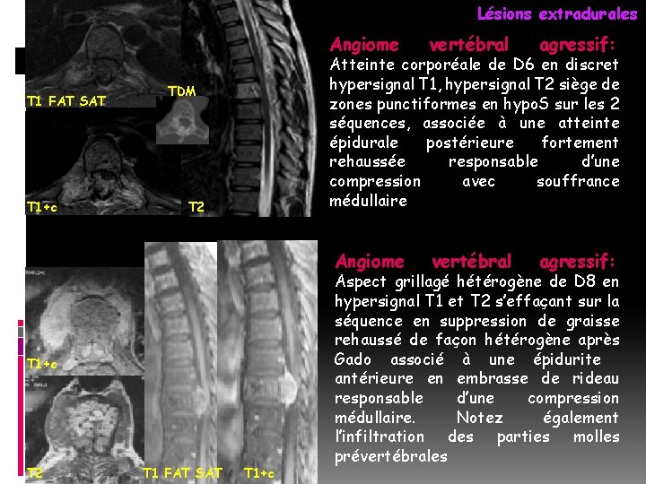 Lésions extradurales T 1 FAT SAT T 1+c TDM T 2 T 1 FAT