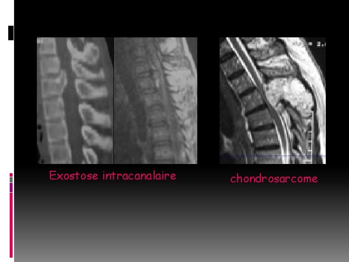 Exostose intracanalaire chondrosarcome 