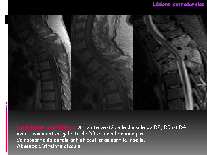 Lésions extradurales Lymphome vertébral: Atteinte vertébrale dorsale de D 2, D 3 et D