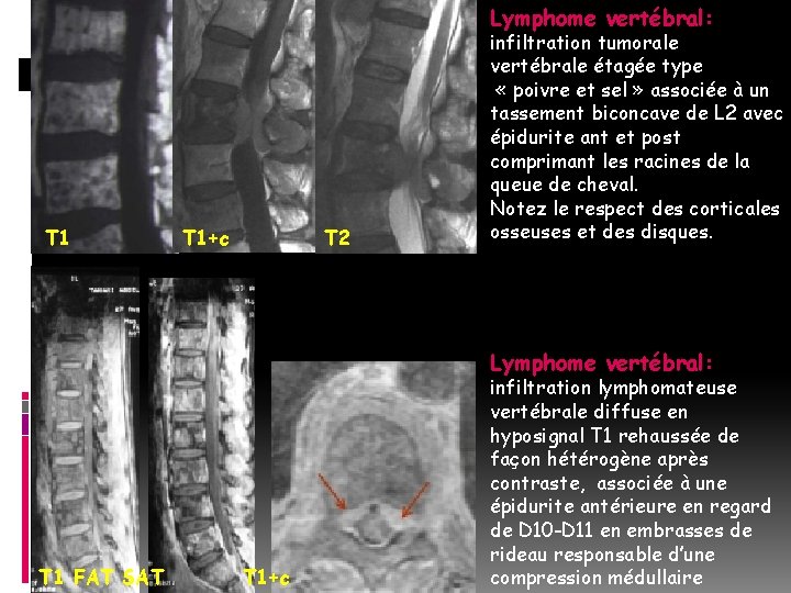 Lymphome vertébral: T 1+c T 2 infiltration tumorale vertébrale étagée type « poivre et