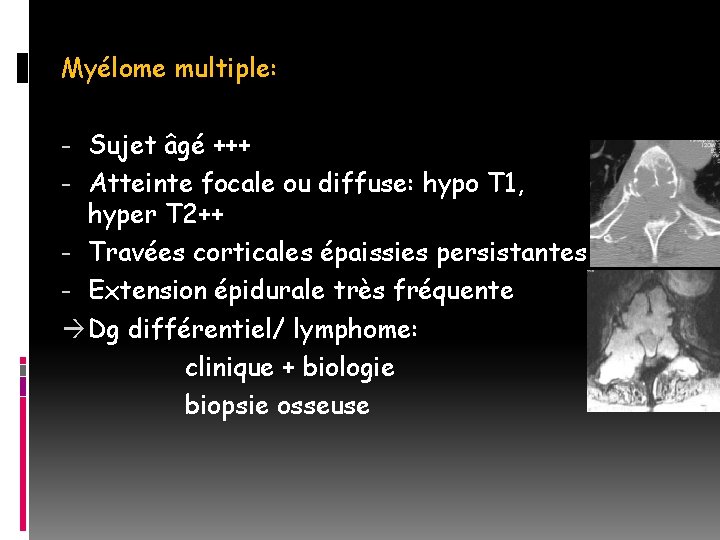 Myélome multiple: - Sujet âgé +++ - Atteinte focale ou diffuse: hypo T 1,