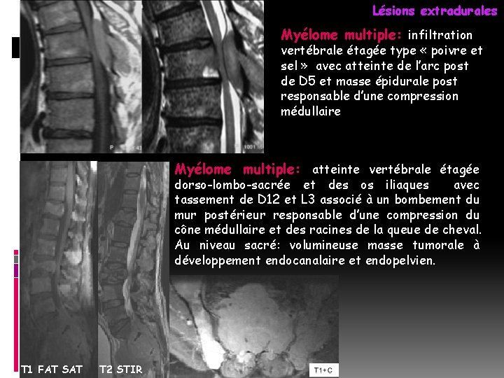 Lésions extradurales Myélome multiple: infiltration vertébrale étagée type « poivre et sel » avec