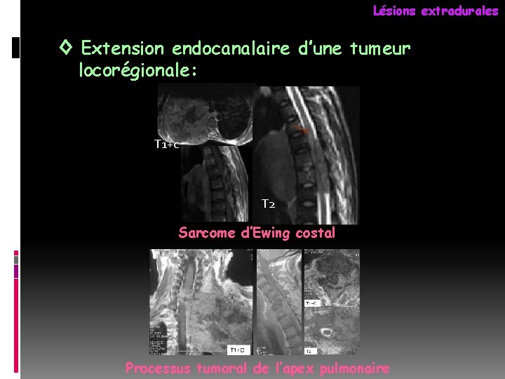 Lésions extradurales ◊ Extension endocanalaire d’une tumeur locorégionale: T 1+c T 2 Sarcome d’Ewing