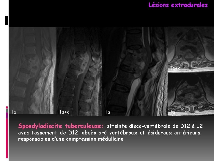 Lésions extradurales T 1+c T 2 Spondylodiscite tuberculeuse: atteinte disco-vertébrale de D 12 à