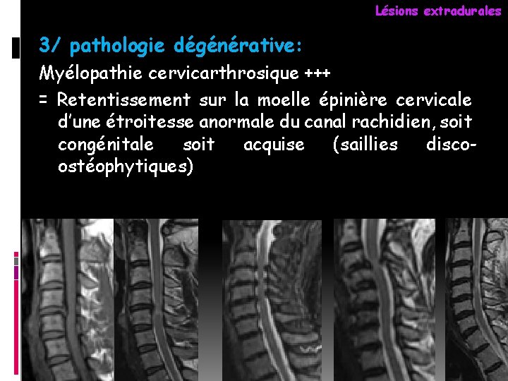 Lésions extradurales 3/ pathologie dégénérative: Myélopathie cervicarthrosique +++ = Retentissement sur la moelle épinière