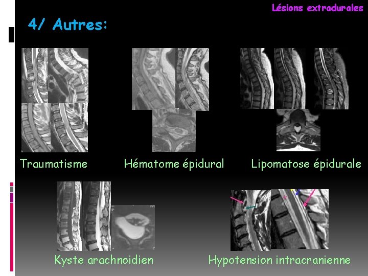 Lésions extradurales 4/ Autres: Traumatisme Hématome épidural Kyste arachnoidien Lipomatose épidurale Hypotension intracranienne 