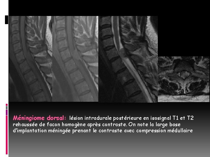 Méningiome dorsal: lésion intradurale postérieure en isosignal T 1 et T 2 rehaussée de