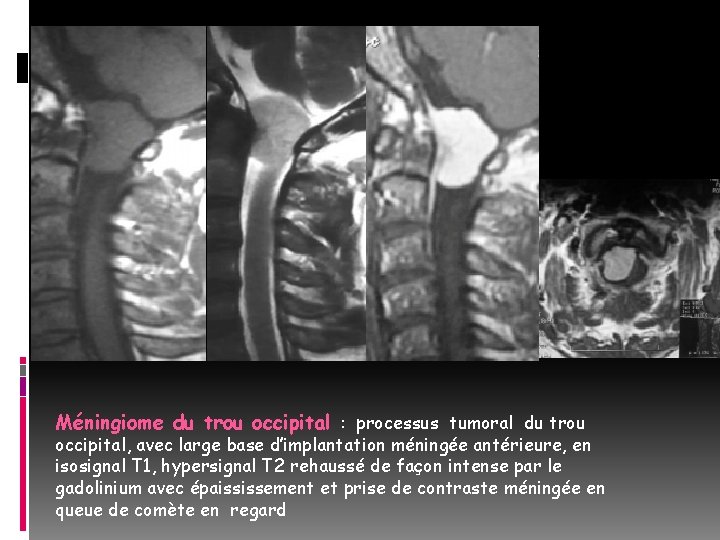 Méningiome du trou occipital : processus tumoral du trou occipital, avec large base d’implantation