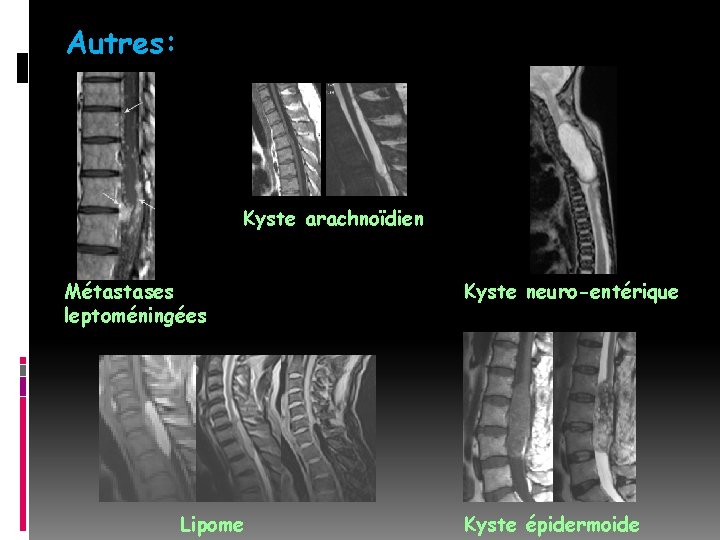 Autres: Kyste arachnoïdien Métastases leptoméningées Lipome Kyste neuro-entérique Kyste épidermoide 