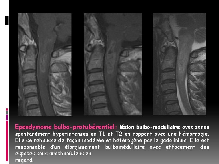 Ependymome bulbo-protubérentiel: lésion bulbo-médullaire avec zones spontanément hyperintenses en T 1 et T 2
