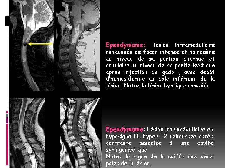 Ependymome: lésion intramédullaire rehaussée de facon intense et homogène au niveau de sa portion