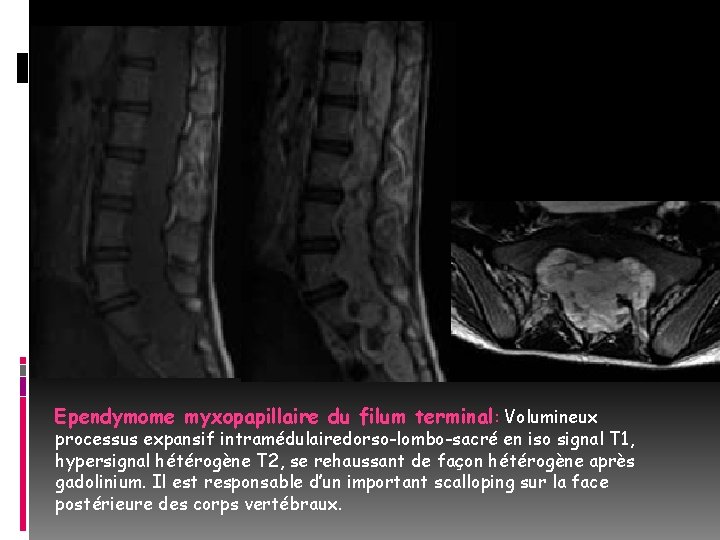 Ependymome myxopapillaire du filum terminal: Volumineux processus expansif intramédulairedorso-lombo-sacré en iso signal T 1,