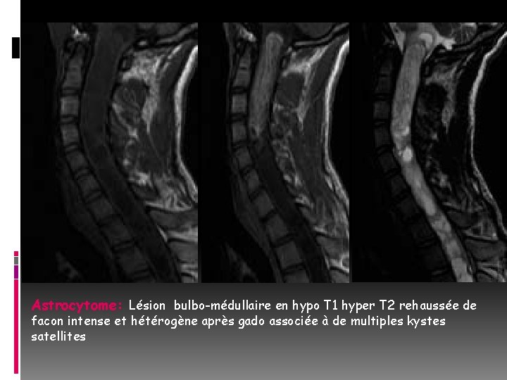 Astrocytome: Lésion bulbo-médullaire en hypo T 1 hyper T 2 rehaussée de facon intense