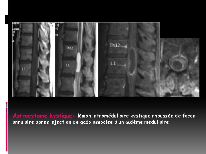Astrocytome kystique: lésion intramédullaire kystique rhaussée de facon annulaire après injection de gado associée