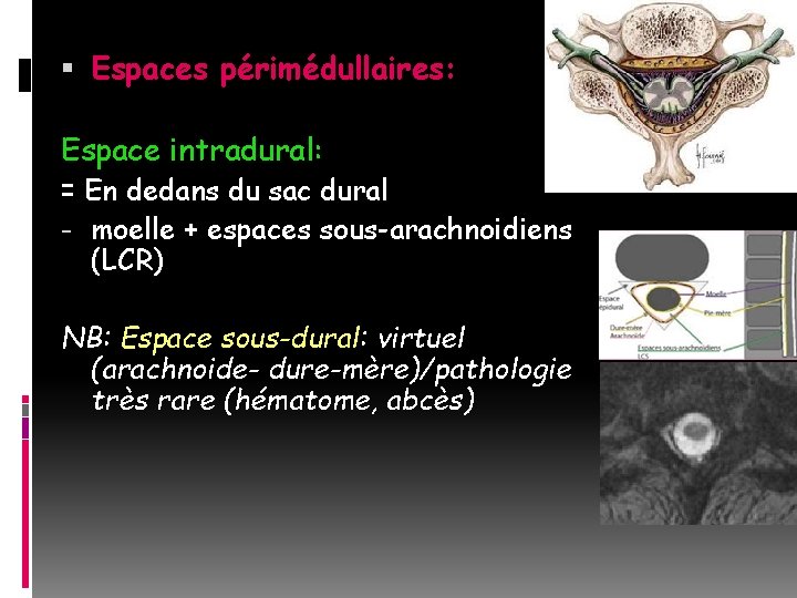  Espaces périmédullaires: Espace intradural: = En dedans du sac dural - moelle +