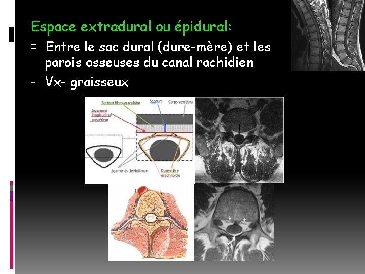Espace extradural ou épidural: = Entre le sac dural (dure-mère) et les parois osseuses