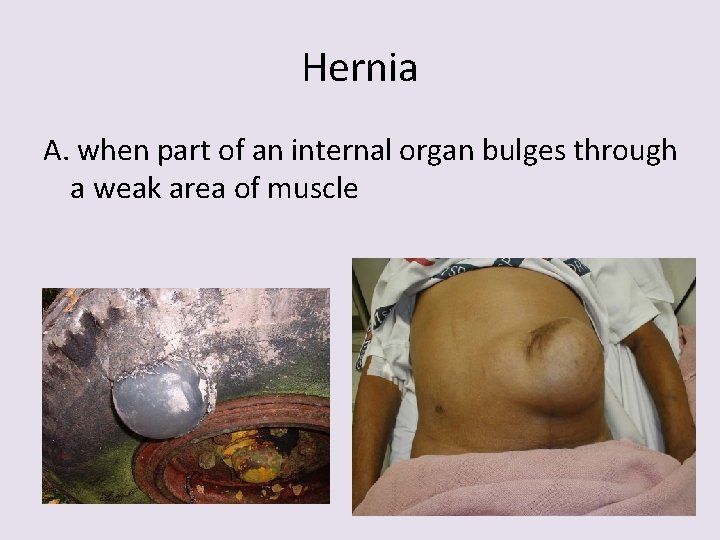 Hernia A. when part of an internal organ bulges through a weak area of